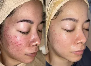 ハーブピーリング /毛穴ケア/脱毛/韓国ツヤ肌専門店【HARU.】所属・韓国ツヤ肌ピーリング ハーブ脱毛HARU.のエステ・リラクイメージ