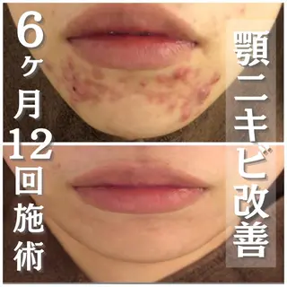 セミロング カラー パーマ ヘアアレンジ メンズ キッズ ネイル マツエク・マツパ アイブロウ 夏までに肌荒れ卒業 するサロン🌻のエステ・リラクイメージ