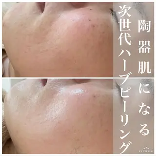 ネイル マツエク・マツパ アイブロウ ニキビ・毛穴改善 🌿ハーブピーリングのエステ・リラクイメージ