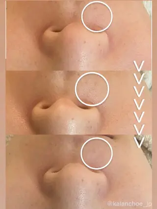 肌質改善 KALANCHOEのエステ・リラクイメージ