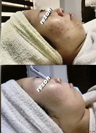 ニキビケア＆ニキビ跡 レゾン京橋店　のエステ・リラクイメージ