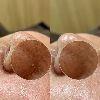 Suu.千種/今池 毛穴洗浄/韓国肌管理のエステ・リラクイメージ