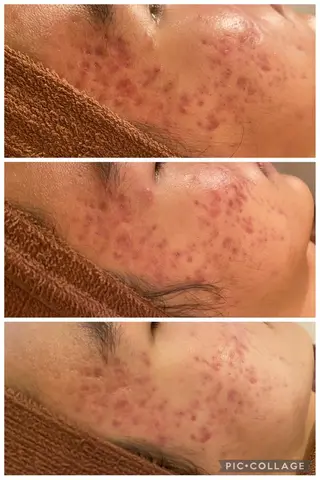 セミロング カラー パーマ ヘアアレンジ メンズ キッズ ネイル マツエク・マツパ アイブロウ 夏までに肌荒れ卒業 するサロン🌻のエステ・リラクイメージ