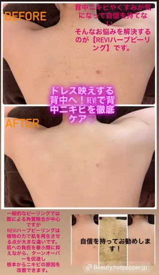 ハーブピーリング/韓国肌管理/フェイシャル/毛穴洗浄/眉毛/顔脱毛【糸脱毛専門】rev所属・ハーブピーリング🌹 毛穴洗浄❤️眉waxのエステ・リラクイメージ