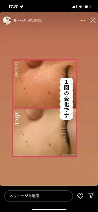 ニキビ跡改善専門🔥 医療にはできない改善のエステ・リラクイメージ