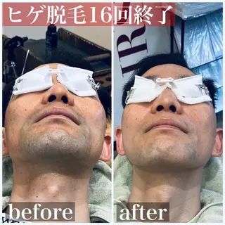 メンズ HAIRS YOSHIOKA所属・ヘアーズヨシオカ MENSヒゲ脱毛のエステ・リラクイメージ