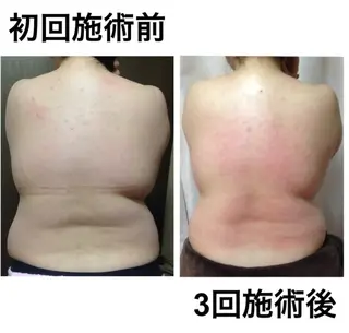 夏までに！ -5kgチャレンジのエステ・リラクイメージ