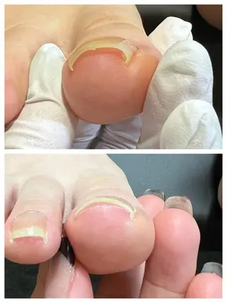 ネイル 巻き爪補正店 堺東店のネイルデザイン