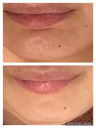 セミロング カラー パーマ ヘアアレンジ メンズ キッズ ネイル マツエク・マツパ 🔥3か月で肌革命 🔥ニキビ専門店のエステ・リラクイメージ