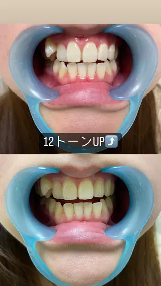 メンズ アイブロウ セルフホワイトニング White33大名のその他イメージ