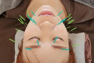 即効⚡小顔美容鍼🪡 むくみたるみ脂肪解消のエステ・リラクイメージ