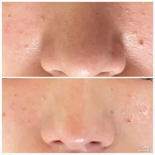 ネイル マツエク・マツパ ニキビ・毛穴改善 🌿ハーブピーリングのエステ・リラクイメージ