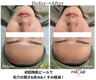 Meupニキビ専門店 背中/ハーブ/肌管理のその他イメージ