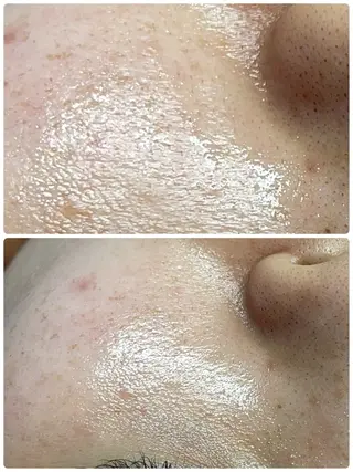 Chalon所属・REVI取扱・肌悩み 毛穴Chalonのエステ・リラクイメージ