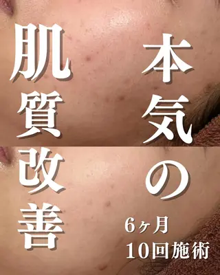 🔥3か月で肌革命 🔥ニキビ専門店のエステ・リラクイメージ