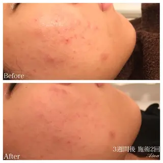 ロング ネイル マツエク・マツパ ニキビ跡専門サロン Ａｉｎａのエステ・リラクイメージ