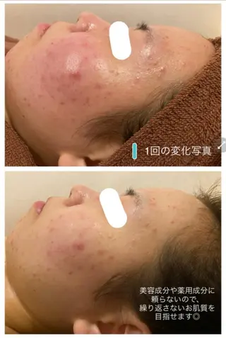🔥3か月で肌革命 🔥ニキビ専門店のエステ・リラクイメージ