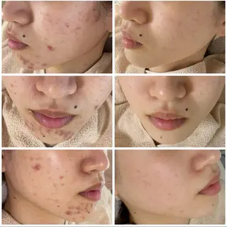 ニキビ&跡改善サロン オーナー光木のエステ・リラクイメージ