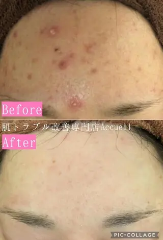 🔥3か月で肌革命 🔥ニキビ専門店のエステ・リラクイメージ