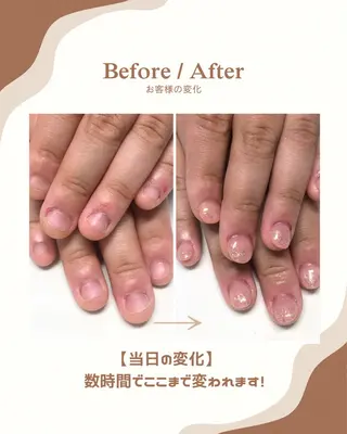 ネイル 深爪矯正・自爪育成 ヴェールリムのネイルデザイン