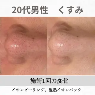 重度ニキビ専門🌷 ダウンタイムなしのエステ・リラクイメージ