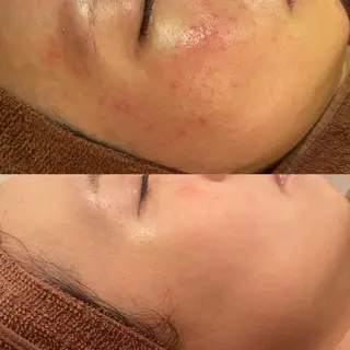 学生ニキビ改善🍀 優しい肌質改善のエステ・リラクイメージ