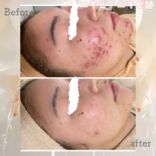 ニキビ&跡改善サロン オーナー光木のエステ・リラクイメージ