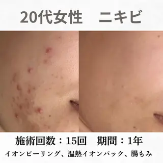 重度ニキビ専門🌷 ダウンタイムなしのエステ・リラクイメージ