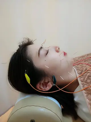 リフトアップ・たるみ ☆美容鍼小顔矯正のその他イメージ