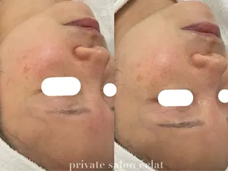 private salon éclat所属・ニキビ・毛穴専門 éclat/エクラのエステ・リラクイメージ