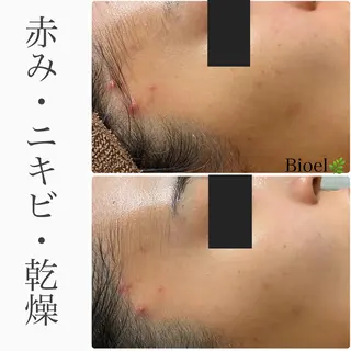 BeSkin藤沢店所属・ニキビ/肌質改善 BeSkin 藤沢店のエステ・リラクイメージ