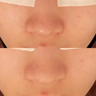 毛穴ケア/毛穴診断/ 毛穴洗浄〔心斎橋〕のエステ・リラクイメージ