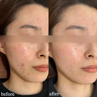 mieux所属・ハーブピーリング ¥6600のエステ・リラクイメージ