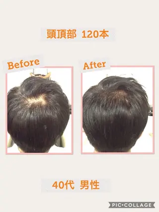 メンズ GRAZIE所属・分け目・つむじ 自然増毛専門のヘアスタイル