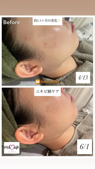 Meupニキビ専門店 背中/ハーブ/肌管理のその他イメージ