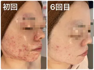 安心の看護師施術 ニキビ改善HAONのエステ・リラクイメージ