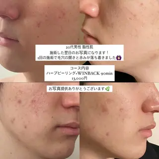 himee所属・艶肌ハーブピーリング /毛穴洗浄のエステ・リラクイメージ