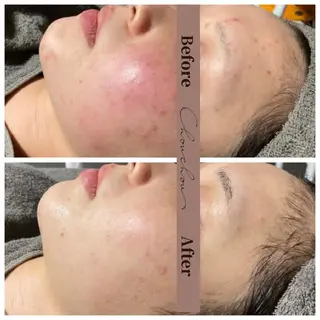 beauty & health salon Chou chou所属・ニキビ・毛穴🌿肌を 育てるララピール✨のエステ・リラクイメージ