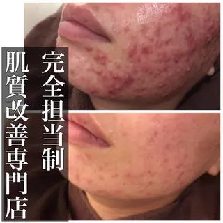 ミディアム カラー パーマ ヘアアレンジ メンズ キッズ ネイル マツエク・マツパ ニキビ・肌質改善専門 ♡人生が変わるサロンのエステ・リラクイメージ