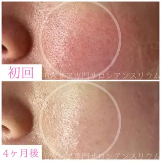 毛穴ケア専門サロンアンスリウム所属・茨城土浦 つくば毛穴 ケア専門サロンのエステ・リラクイメージ