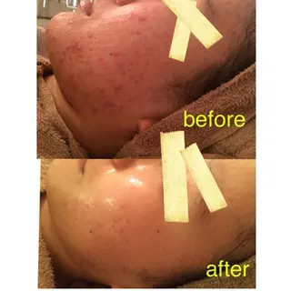 フェイシャル専門 肌質改善/プランスのエステ・リラクイメージ