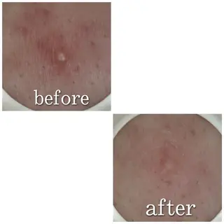 ショート カラー パーマ ヘアアレンジ メンズ キッズ ネイル マツエク・マツパ アイブロウ ニキビ特化型エステ 🍓最短で肌質改善のエステ・リラクイメージ