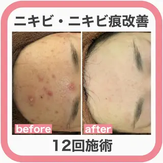 ニキビ跡改善専門🔥 医療にはできない改善のエステ・リラクイメージ