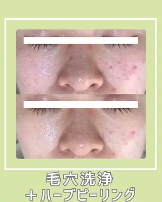 |ピーリング・毛穴| soina神楽坂のエステ・リラクイメージ