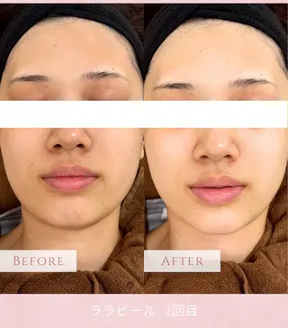 美肌毛穴ケア/看護師 🌷ナスサロmanaのエステ・リラクイメージ