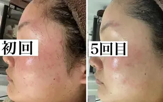 中目黒ハーブピーリン グ🌿ララピールのエステ・リラクイメージ