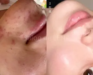 ハーブピーリング・毛穴ケア専門サロンSalon de LENA 栄店所属・ハーブピーリング専門 サロンドレナ　白藤のエステ・リラクイメージ