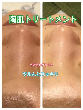 【リベルハーブピーリング認定店】敏感肌・美白脱毛専門店Dione立川店所属・Dione 立川店のエステ・リラクイメージ