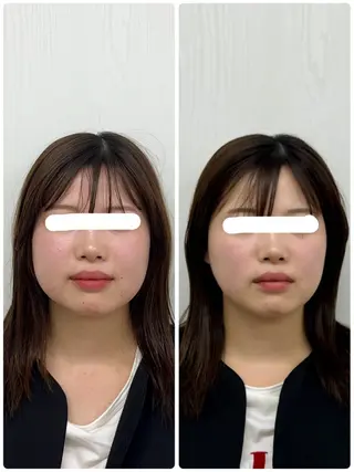 美容鍼×小顔矯正 ×美容整体　浜川泰仁のエステ・リラクイメージ