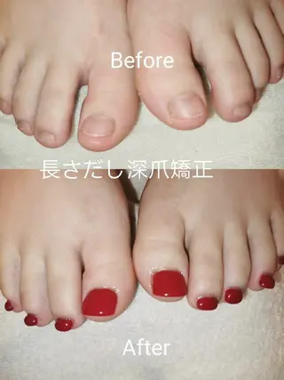 ネイル フィルイン、長さ出し 深爪矯正のネイルデザイン